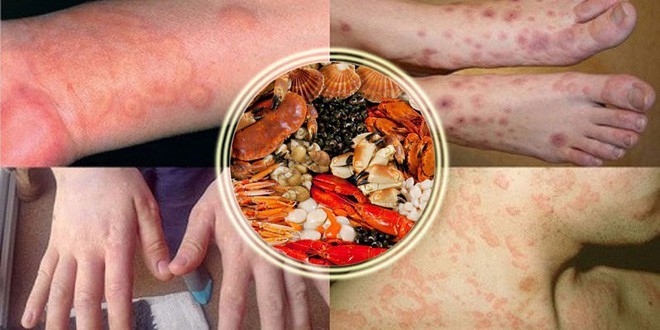  Đánh giá nguy cơ ngộ độc Histamine từ việc tiêu thụ cá họ Scombridae ở Nghệ An, Việt Nam